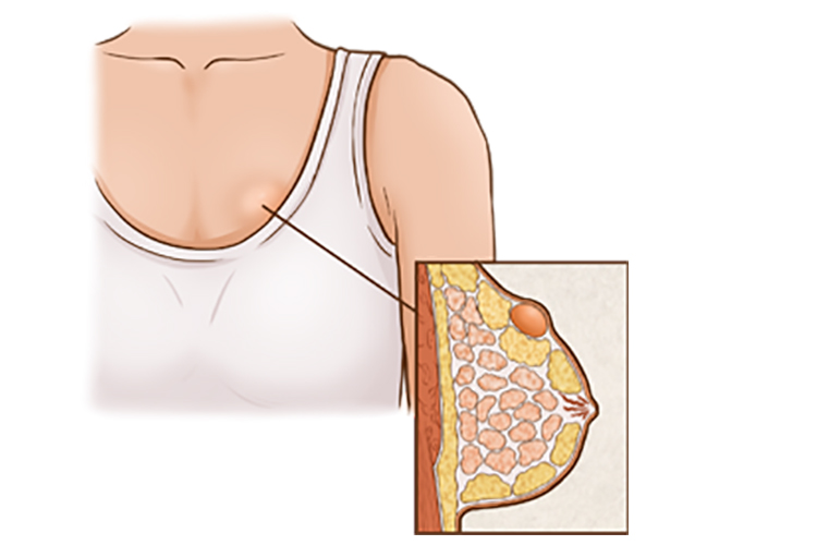 乳腺结节的症状及图片