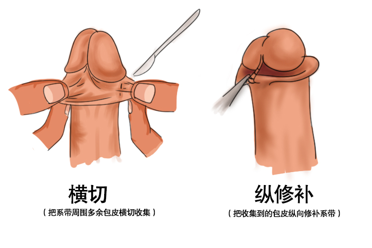 系带延长术图
