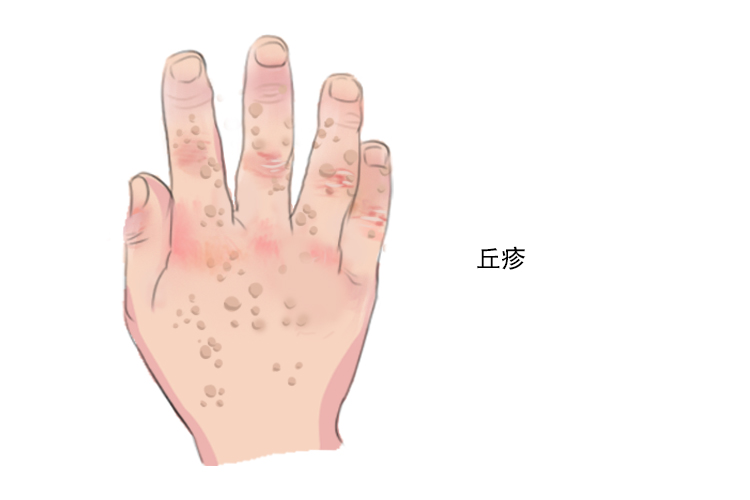 hpv感染手指皮肤图