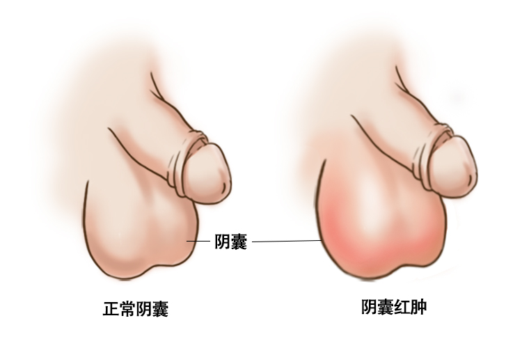 阴囊肿是什么症状图片图片