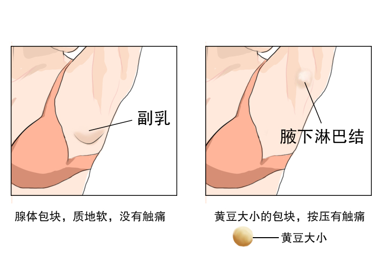 副乳和腋下淋巴结肿大区别图