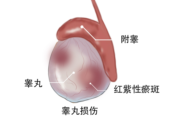 睾丸损伤图