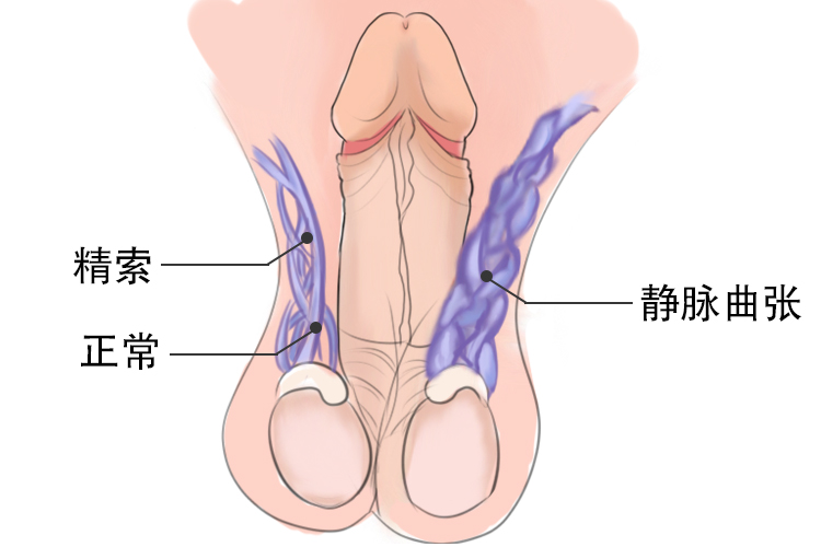 精索静脉曲张图