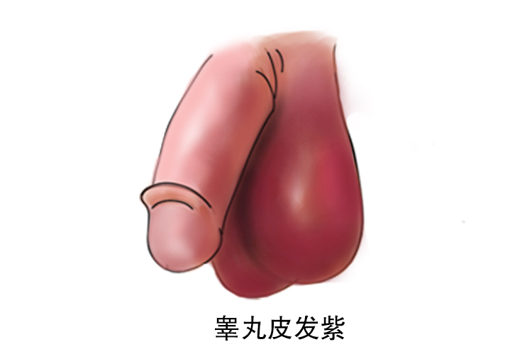 睾丸炎图