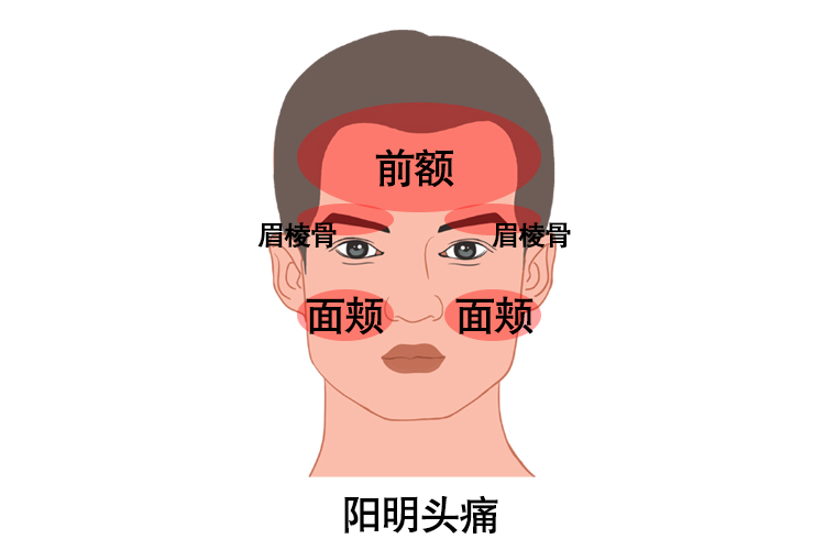 太阳头痛:【部位】六经头痛一般指太阳头痛,阳明头痛,少阳头痛,太阴