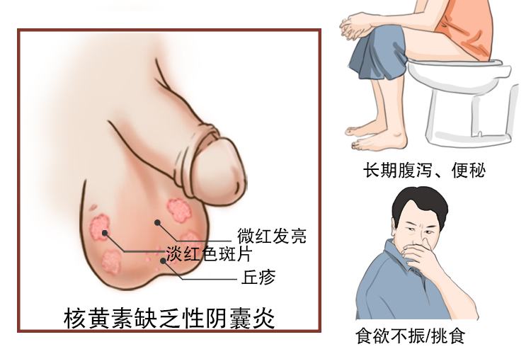 阴道炎图片