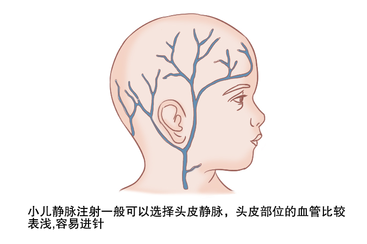 静脉输液示意图图片