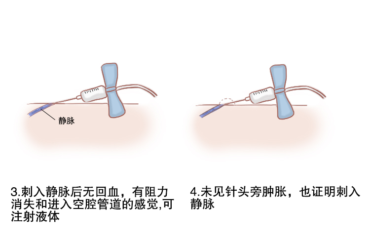 小儿静脉输液部位图解