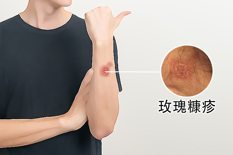 玫瑰真菌感染