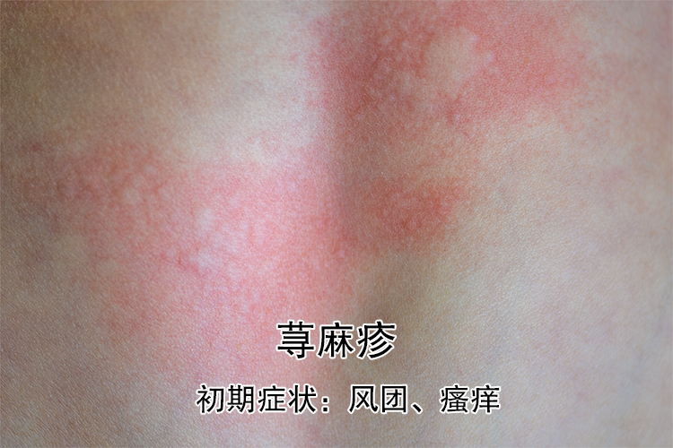 过敏性荨麻疹图