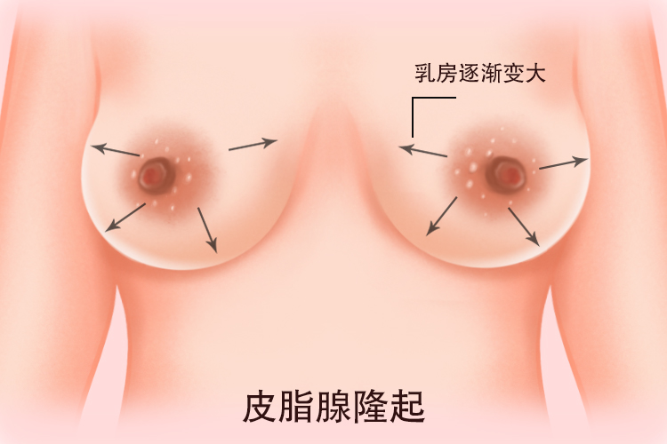 皮脂腺隆起图片