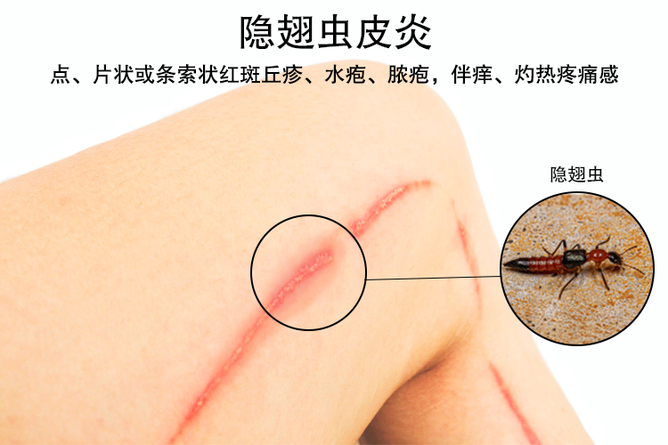 隐翅虫皮炎图片