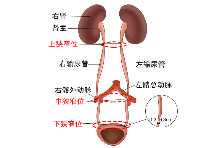 输尿管三个狭窄图