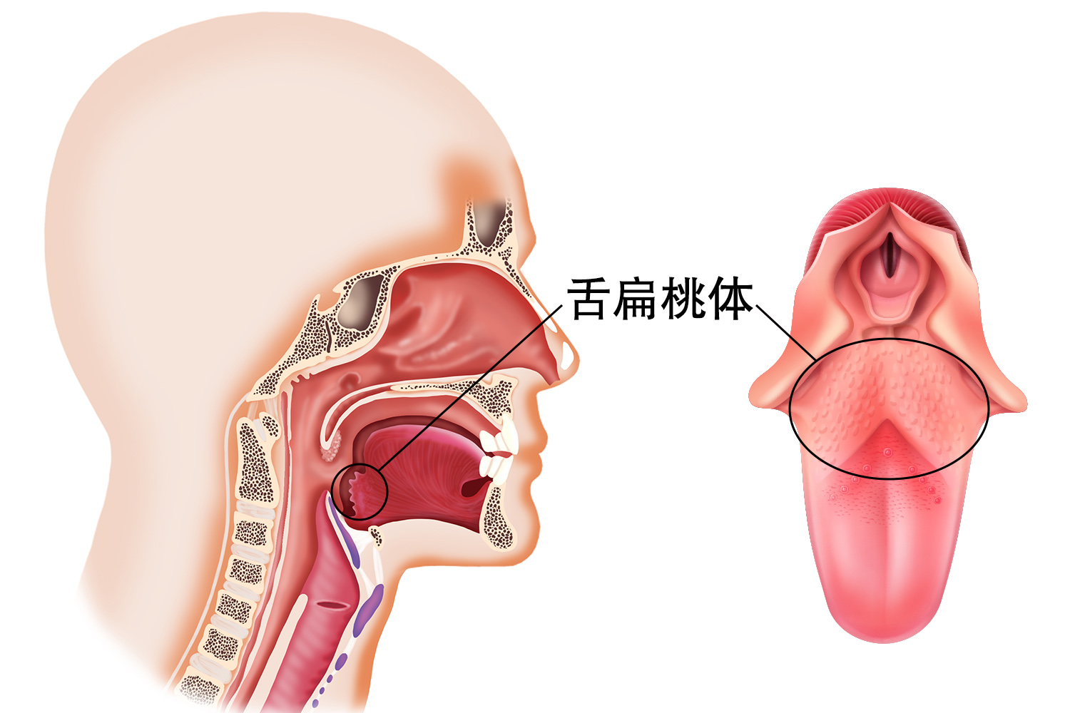 舌扁桃体图