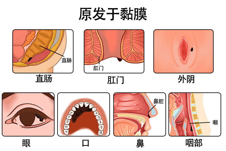 黑色素瘤好发部位图