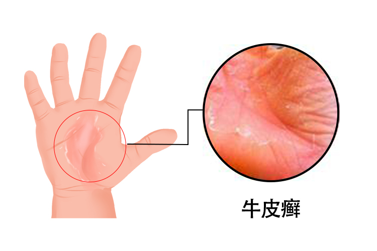 牛皮癣图