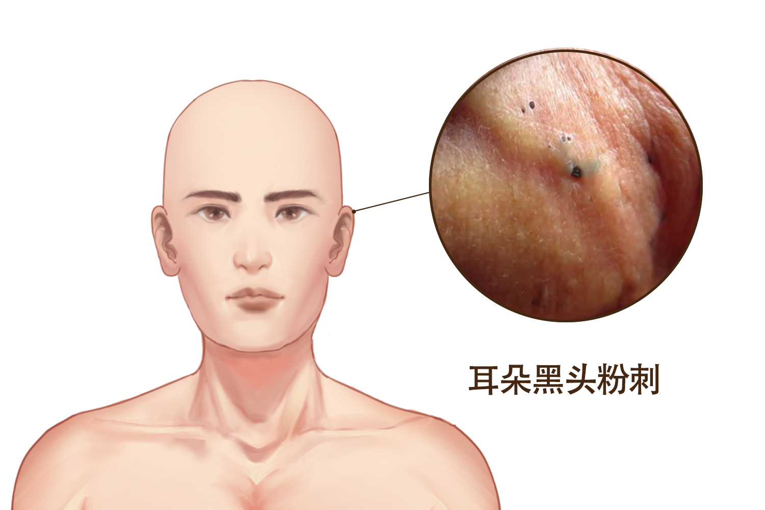 痤疮耳朵图3