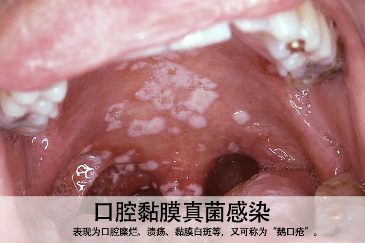 口腔黏膜真菌感染图