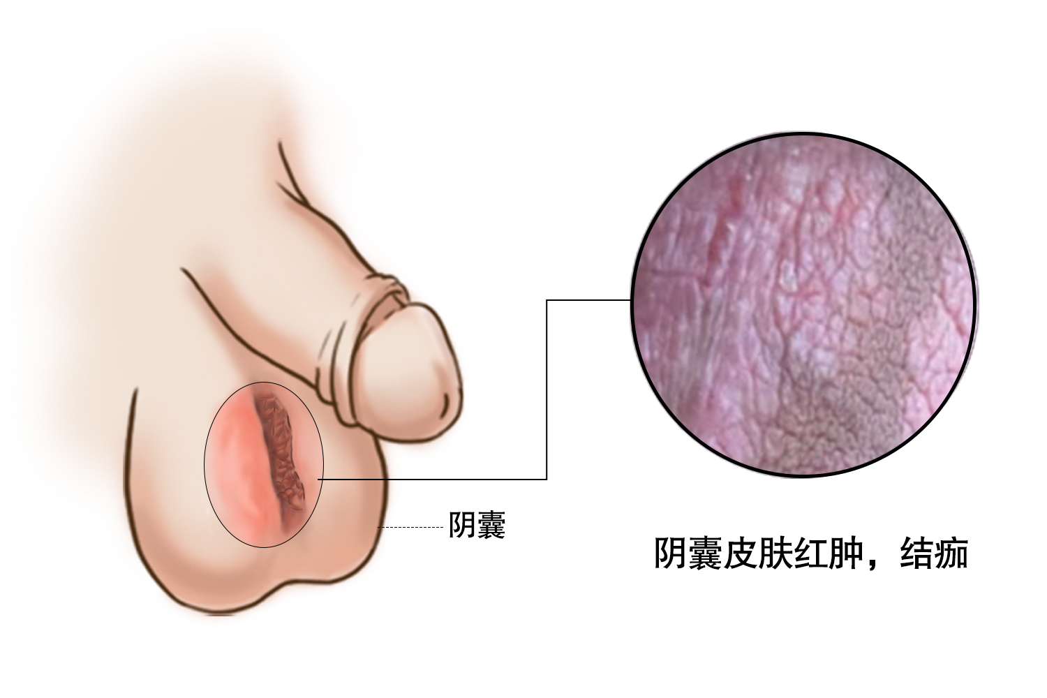 阴囊红肿结痂图