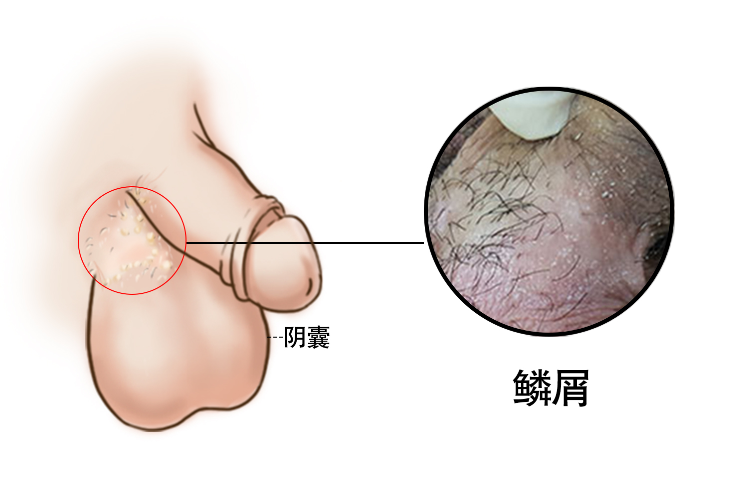 阴囊鳞屑图