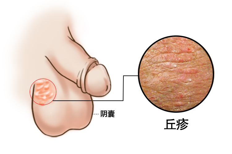 阴囊丘疹图