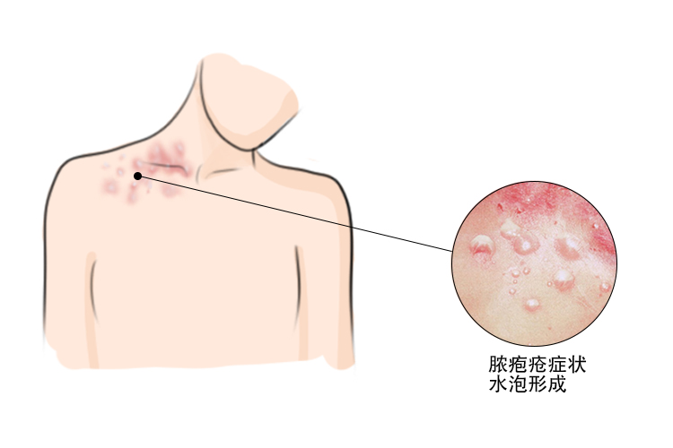脓疱疮形成图2