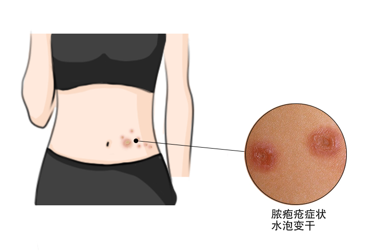 脓疱疮变干图3