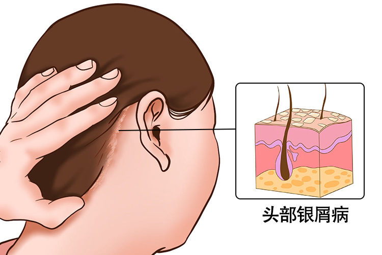 银屑病图