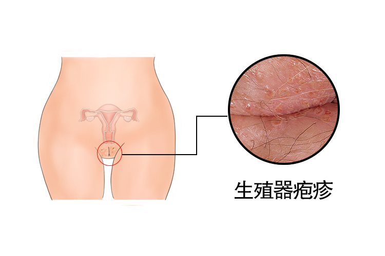 女性生殖器疱疹图2