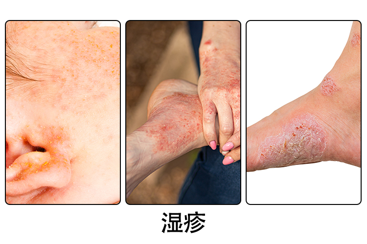 湿疹症状图
