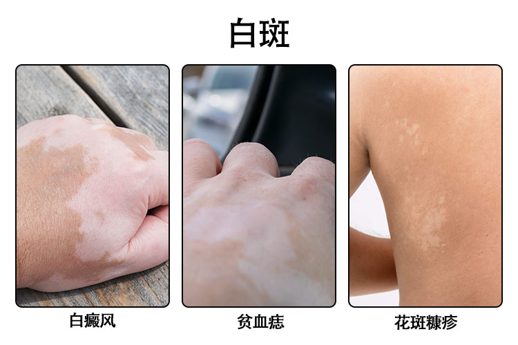 白斑病图