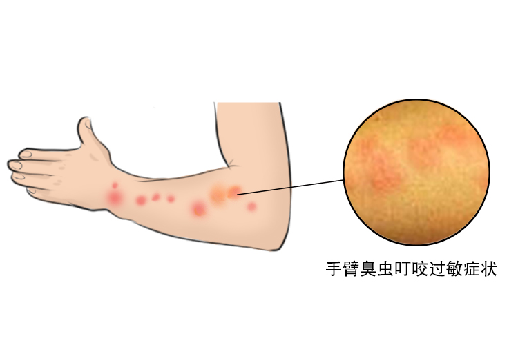 手臂过敏图