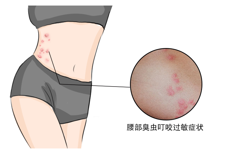 腰部过敏图