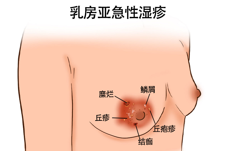 乳房亚急性湿疹图