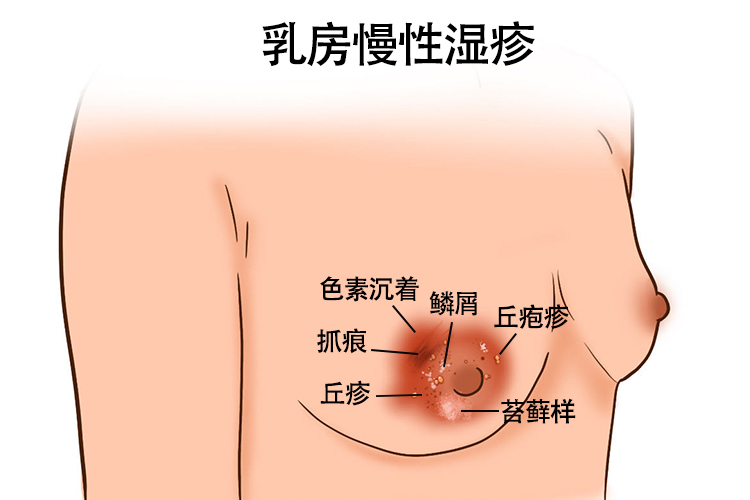 乳房慢性湿疹图