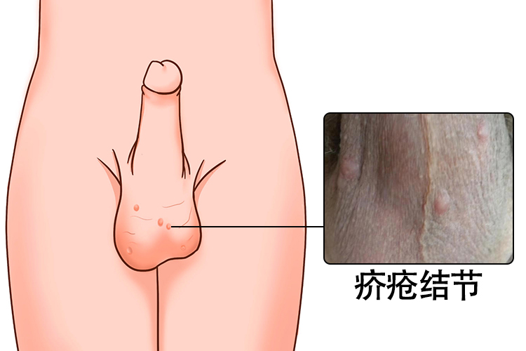 疥疮结节图