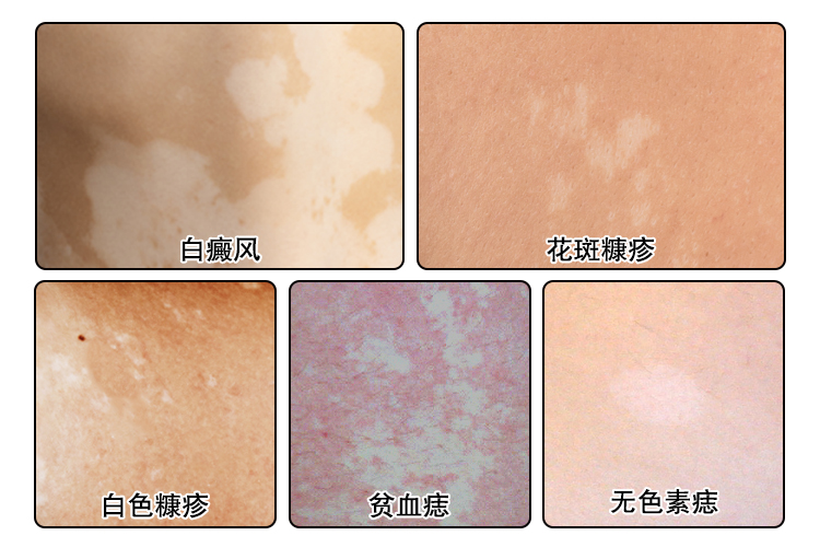 皮肤黏膜色素脱失图2
