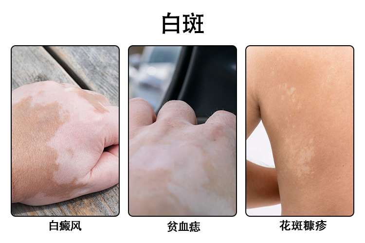 白斑图