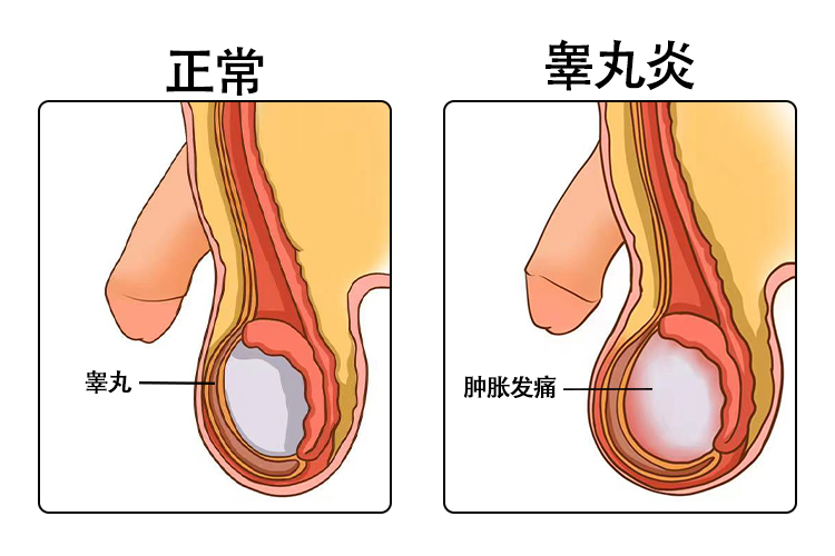 睾丸炎图