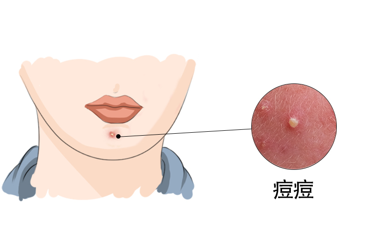 男生下巴长痘痘图片