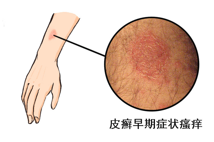 瘙痒图片
