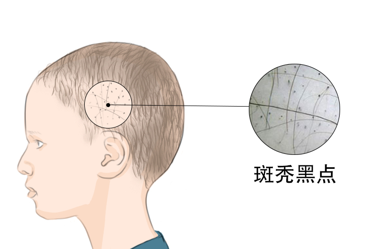 小孩头发斑秃2