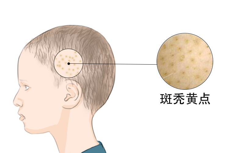 小孩头发斑秃3