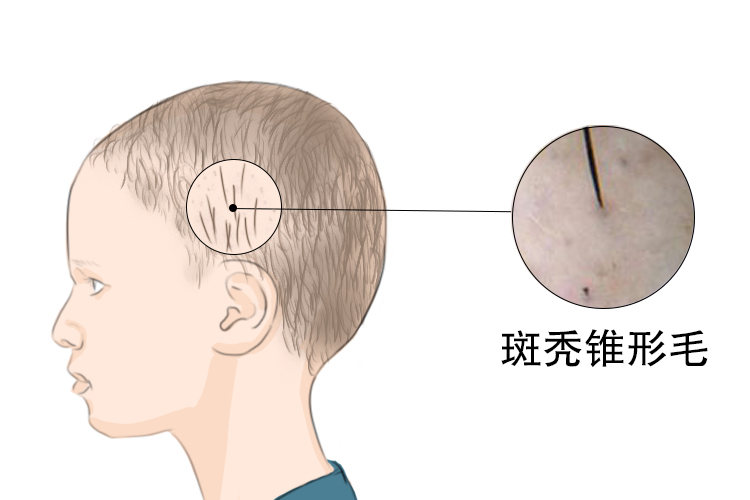 小孩头发斑秃4