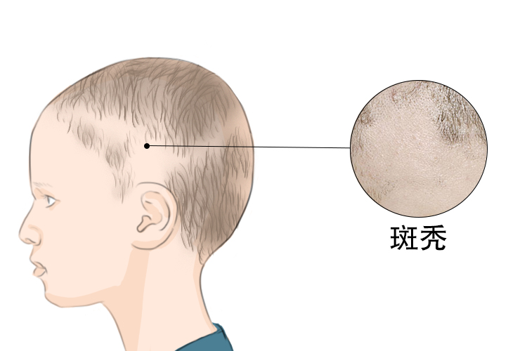 小孩头发斑秃6