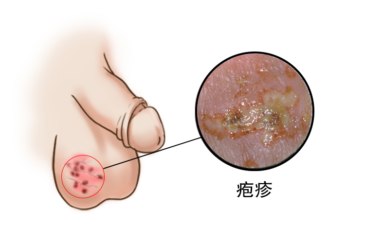 男性疱疹图片