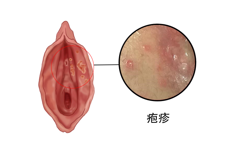 女性阴道疱疹图片