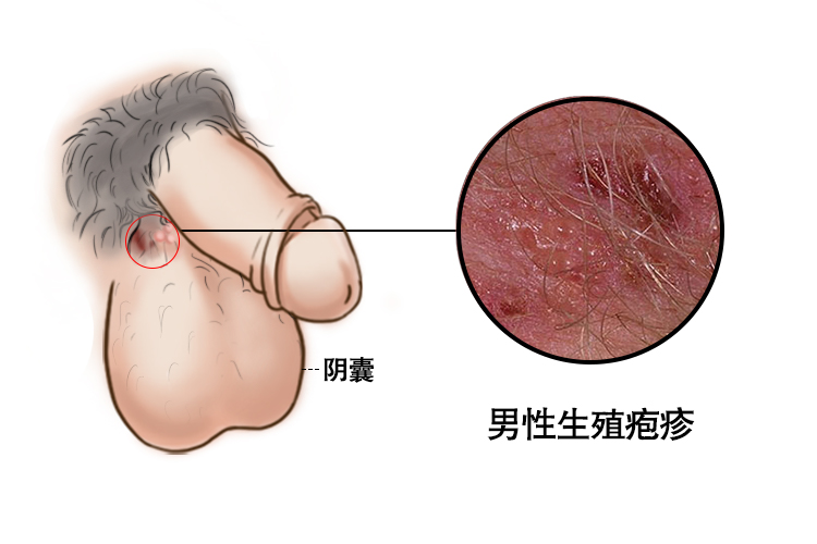 生殖疱疹2