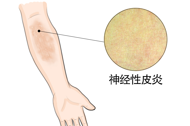 神经性皮炎图片