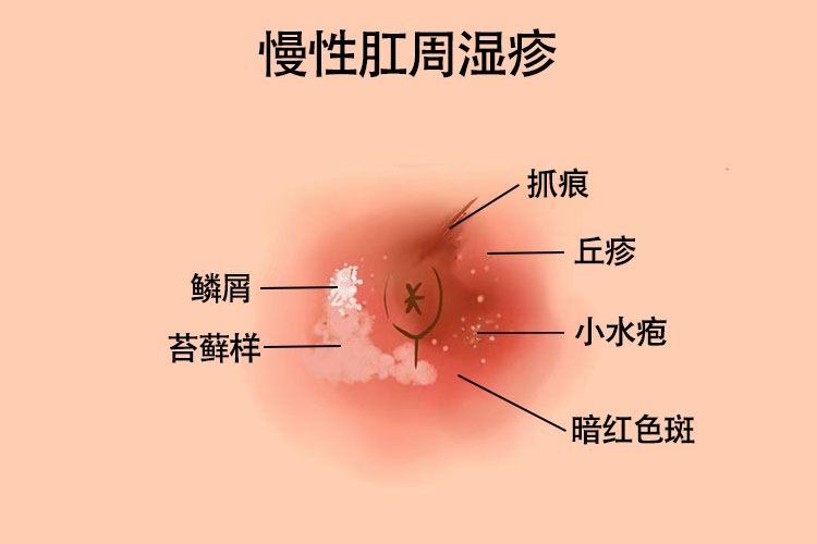 慢性肛周湿疹图